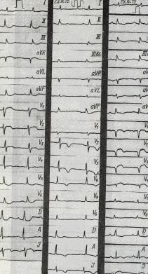 Criterii electrocardiografice pentru infarctul miocardic