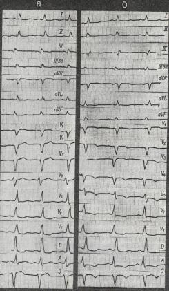 Criterii electrocardiografice pentru infarctul miocardic