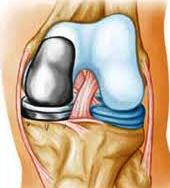 Endoproteza articulației genunchiului - tipuri de proteze