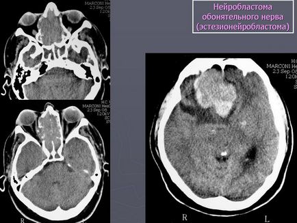 Estesioneuroblastomul cauzat de cavitatea nazală, simptomele și tratamentul