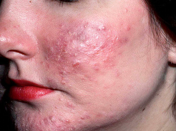 A follikuláris dermatitis kezelésére, a tünetek és okok a betegség, egészséges internetes