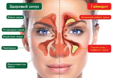 Гайморит без проколу