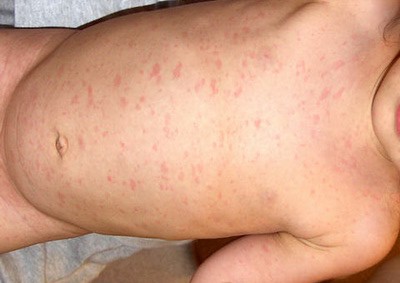Tipul herpesului 6 la copii simptome (foto), tratament, prevenire