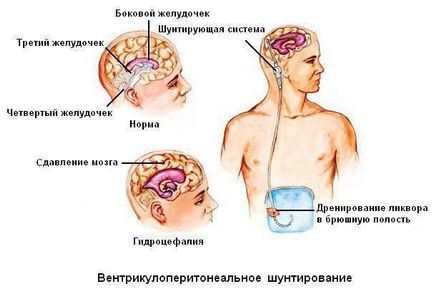 Hidrocefalul creierului - imediat la medic!