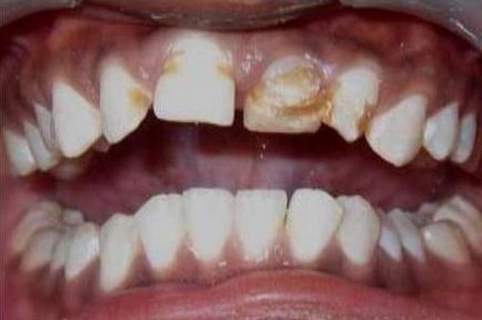Hipoplazia cauzată de cauzele și tratamentul smalțului dinților