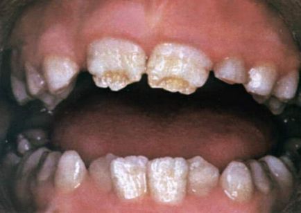 Hipoplazia cauzată de cauzele și tratamentul smalțului dinților