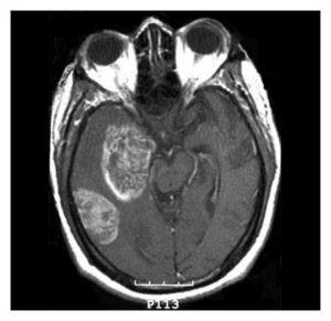 Glioblastomul creierului provoacă, simptome, tratament, nutriție, prognostic