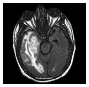 Glioblastomul creierului provoacă, simptome, tratament, nutriție, prognostic