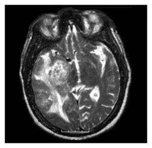 Glioblastomul creierului provoacă, simptome, tratament, nutriție, prognostic