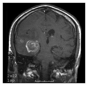 Glioblastomul creierului provoacă, simptome, tratament, nutriție, prognostic