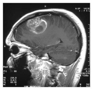 Glioblastoma agy okoz, tünetei, kezelés, élelmiszer, előrejelzés