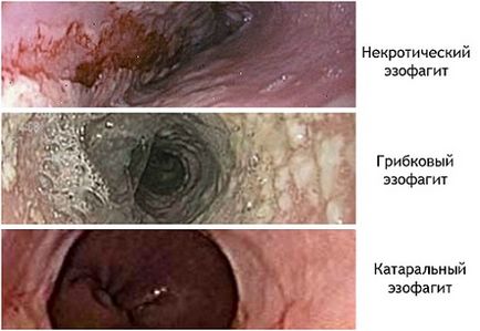 Грибковий езофагіт як лікувати гостру і хронічну форму