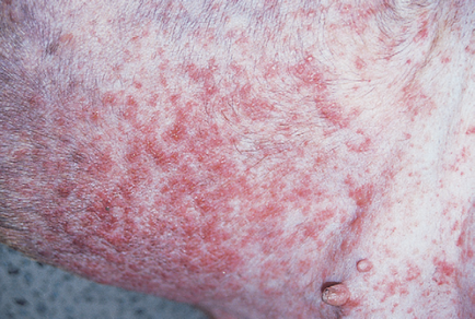 Ce probleme ale pielii pot provoca dermatomicoză și hipotiroidism