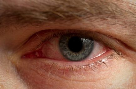 Hogyan kell kezelni blepharitis szem