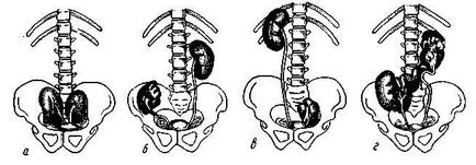 Як лікувати дістопію нирок лівої і правої