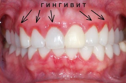 Як лікувати катаральний гінгівіт у дітей фото, симптоми і лікування