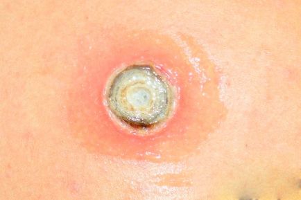 Care ar trebui să fie prevenirea recomandării melanomului