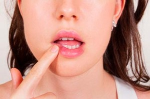 Як запобігти герпес на ранній стадії на губах