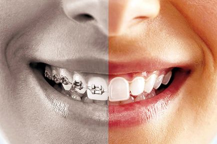 Капи invisalign (Инвизилайн) прозорі елайнери для вирівнювання зубів