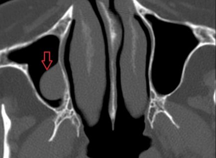 Chist în fotografie nas și descrierea cazurilor clinice