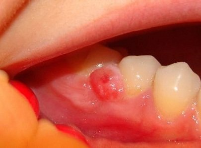 Кіста зуба у дітей