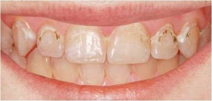 Clasificarea cariilor, gradul de carii, streptococcus mutans