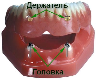 Кнопковий замок для фіксації знімного зубного протеза