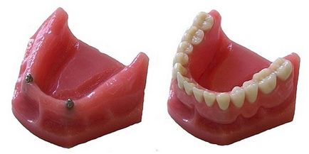 Кнопковий замок для фіксації знімного зубного протеза
