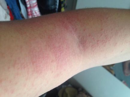 Urticaria din cauza alcoolului provoaca aparitia, pot bea, tratament