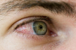 Hemoragia simptomelor oculare, cauze, tratament