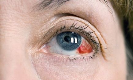 Hemoragia simptomelor oculare, cauze, tratament