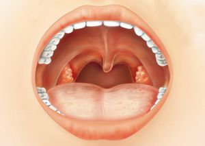 Lacunaris angina és mandulagyulladás különbözik (angina) Lacunaris mandulagyulladás és mandulagyulladás különbözik