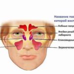 Tratamentul sinuzitei maxilare fără pătrunderea cât de repede se poate scăpa