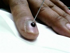 nail gomba fajta kéz gombák nail jelek kezelése
