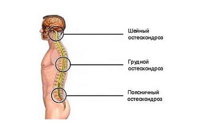 Tratamentul vârfurilor de osteocondroză și al rețetelor