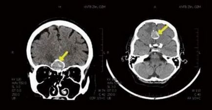 Meningioma simptome, tratament, semne și diagnostic