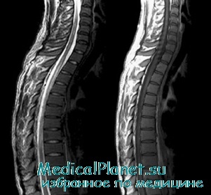 Myelodysplasia gyermekeknél okoz, diagnózis, kezelés (gyermek) Myelodysplasia gyermekeknél okoz, diagnózis, kezelés