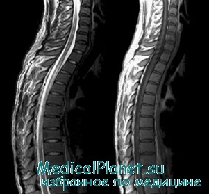 Myelodysplasia la copii, cauze, diagnostic, tratament