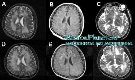 Myelodysplasia la copii, cauze, diagnostic, tratament