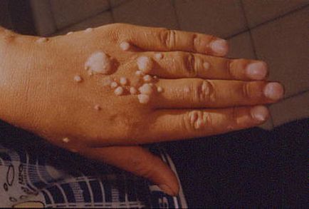 Az Egészségügyi Minisztérium azt mondta, papilloma és szemölcs betegség tart! (Papilloma) Az Egészségügyi Minisztérium azt mondta, papilloma és szemölcs betegség tart!