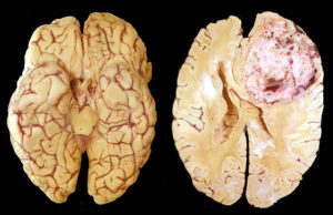 Glioblastoma multiforme esetén - okai, tünetei, kezelése fókusz