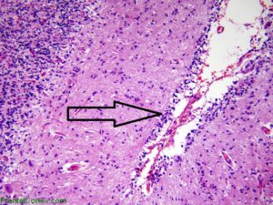 Glioblastomul multiform - cauze, simptome, metode de bază de tratament