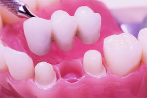 Нейлонові зубні протези переваги і недоліки