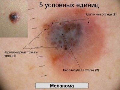 Небезпечна краса мелонома і її лікування