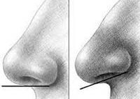 Опущений, піднятий кінчик носа - причини, симптоми, діагностика та лікування