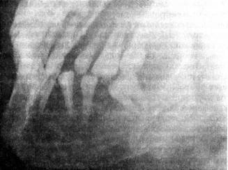 Tumorile fălcilor de osteoblastoclastom