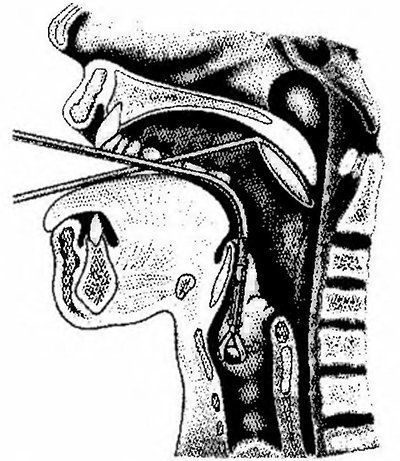 Tumorile laringelui