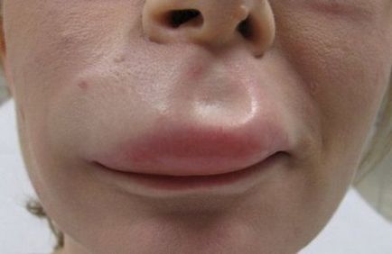 Angioedema gyermekeknél a tünetek, okok és kezelés