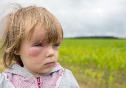 Angioedema gyermekeknél a tünetek, okok és kezelés