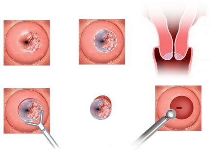 Papilloma méhnyak (cervix papillomák) Papilloma a méhnyakon